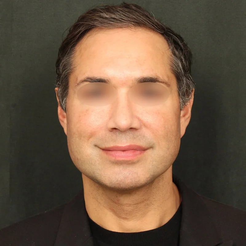 Deep plane facelift Before & After Image