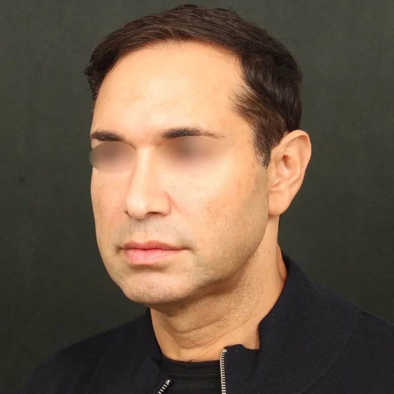 Deep Plane Facelift & Neck Lift Before & After Image