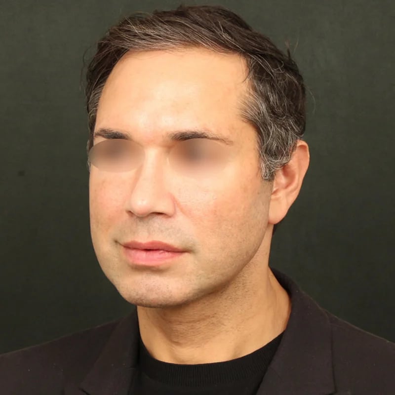 Deep Plane Facelift & Neck Lift Before & After Image
