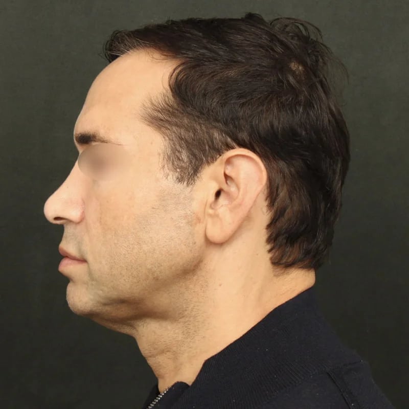Deep Plane Facelift & Neck Lift Before & After Image