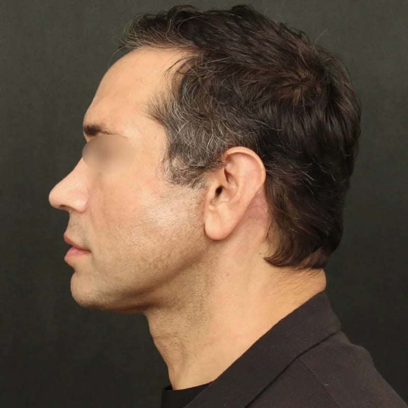 Deep Plane Facelift & Neck Lift Before & After Image