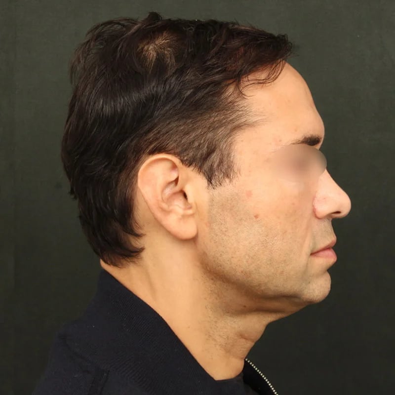 Deep Plane Facelift & Neck Lift Before & After Image