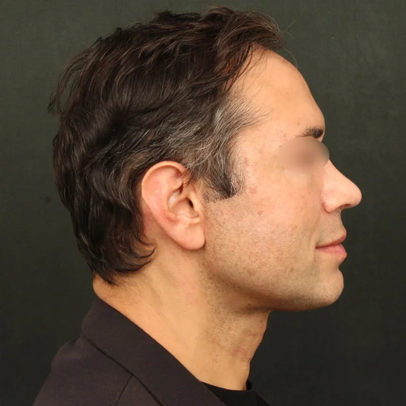 Deep Plane Facelift & Neck Lift Before & After Image