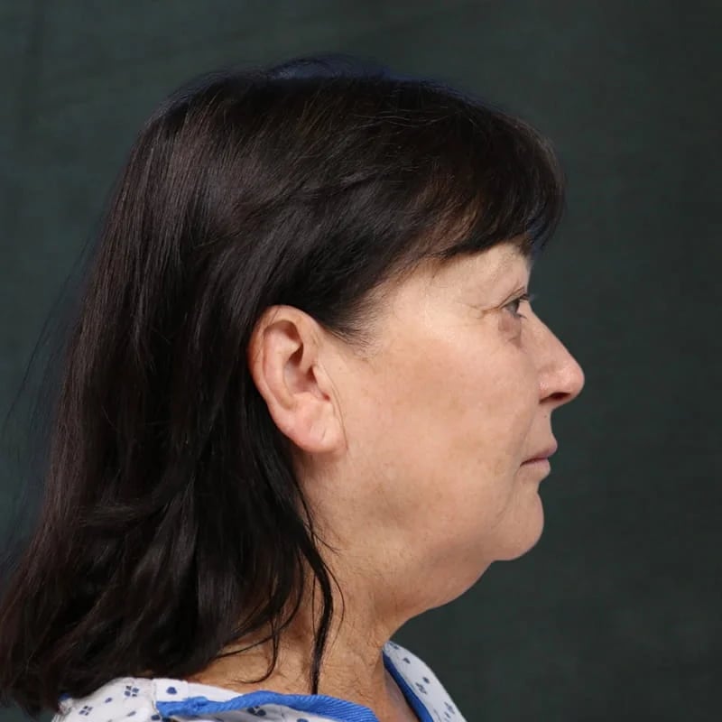 Deep plane facelift Before & After Image