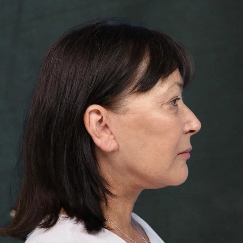 Deep plane facelift Before & After Image