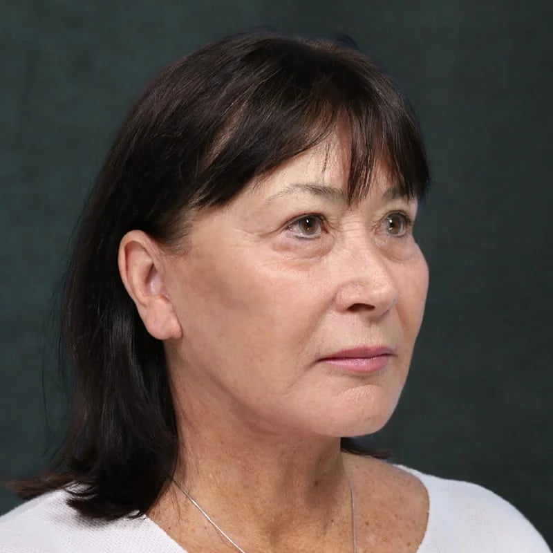 Deep plane facelift Before & After Image