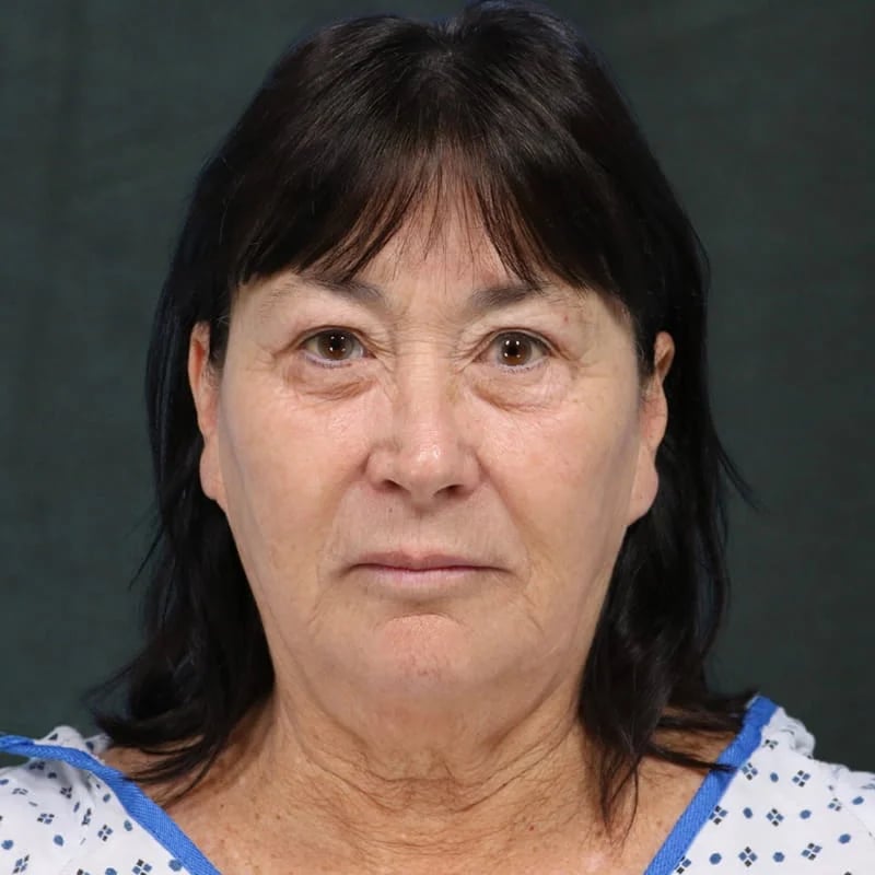 Deep Plane Facelift & Neck Lift Before & After Image