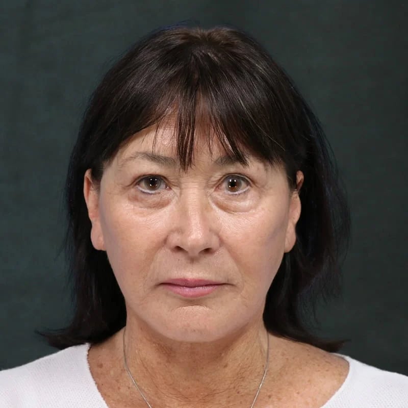 Deep Plane Facelift & Neck Lift Before & After Image