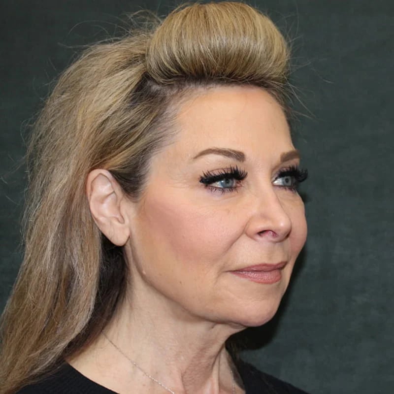Deep Plane Facelift & Neck Lift Before & After Image