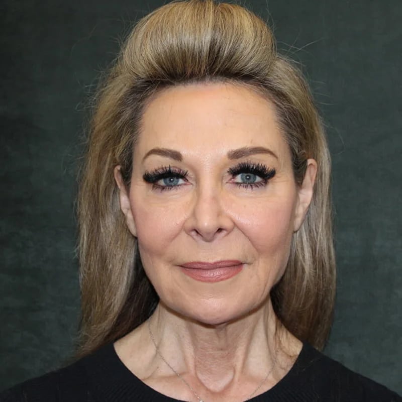 Deep Plane Facelift & Neck Lift Before & After Image