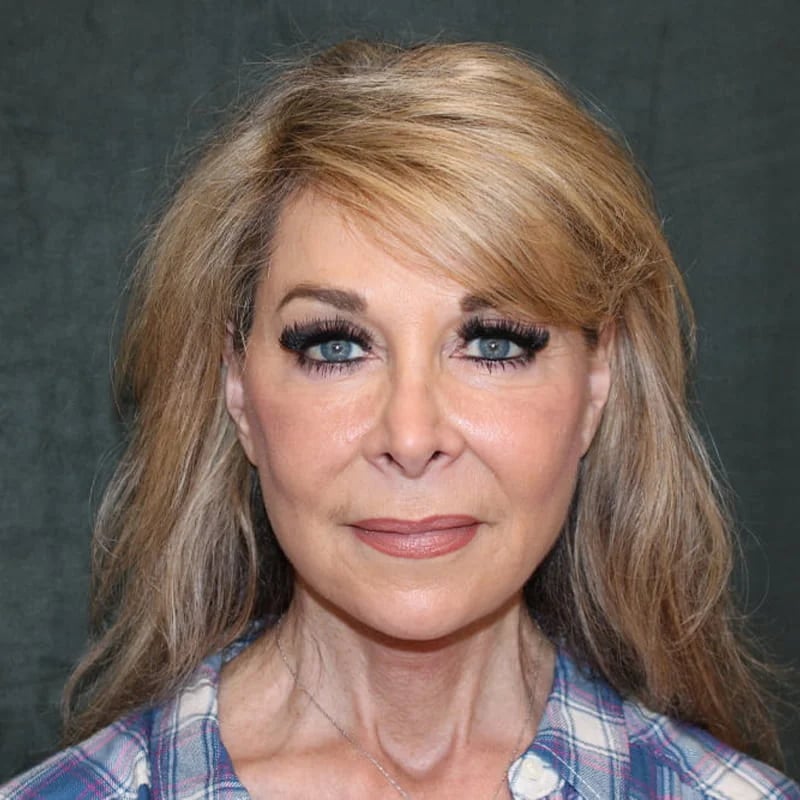 Deep Plane Facelift & Neck Lift Before & After Image