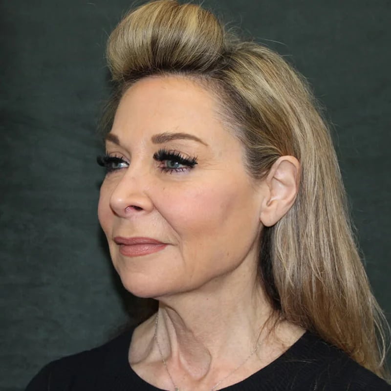 Deep plane facelift Before & After Image