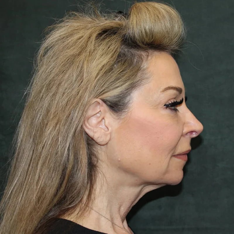 Deep Plane Facelift & Neck Lift Before & After Image