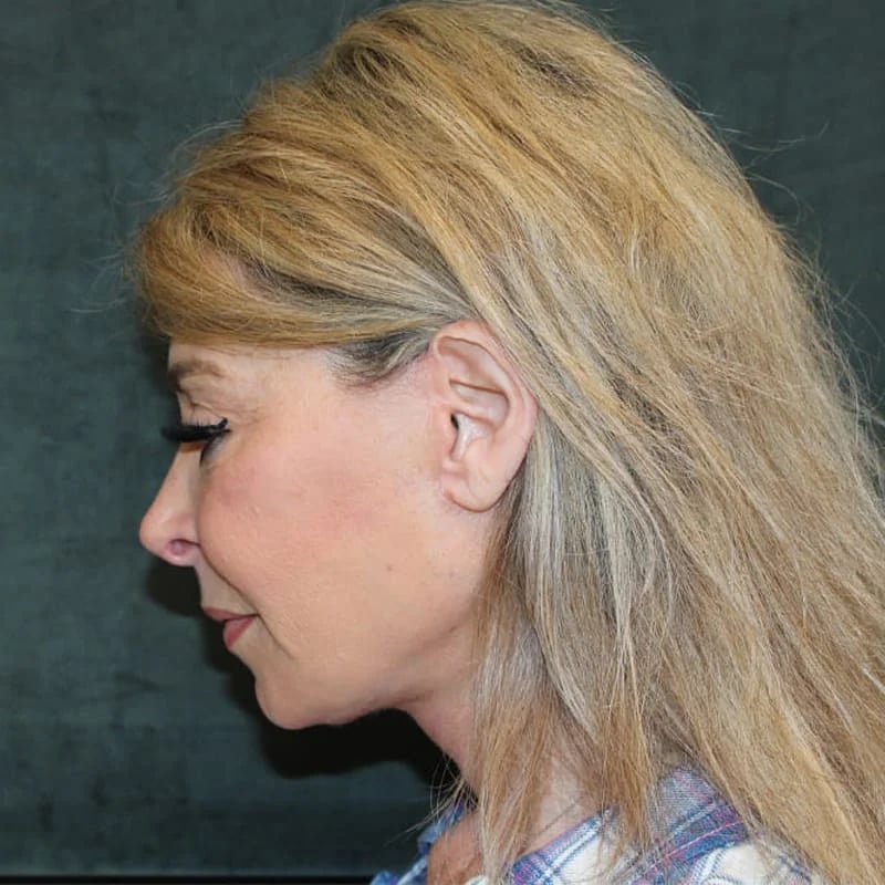 Deep Plane Facelift & Neck Lift Before & After Image