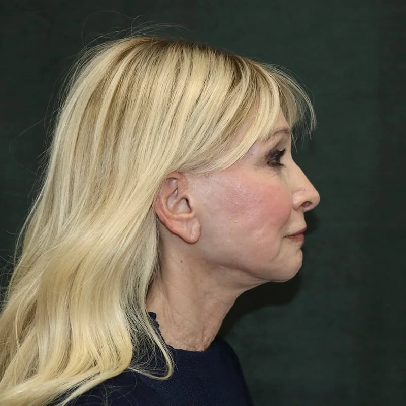 Deep plane facelift Before & After Image