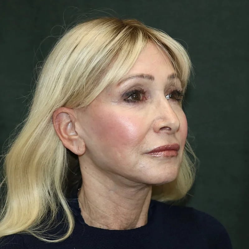Deep plane facelift Before & After Image