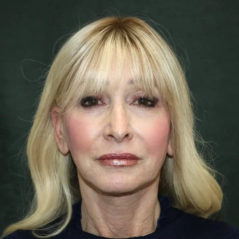 Deep Plane Facelift & Neck Lift Before & After Image