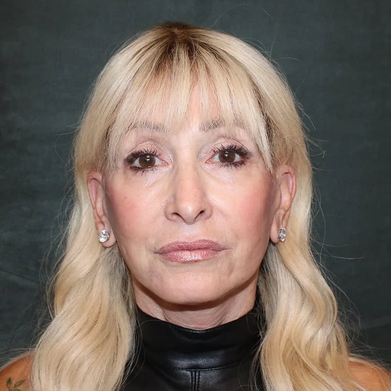 Deep Plane Facelift & Neck Lift Before & After Image