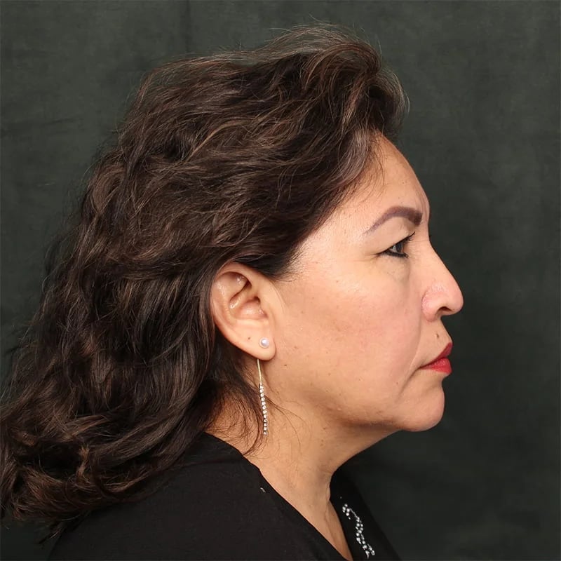 Deep plane facelift Before & After Image