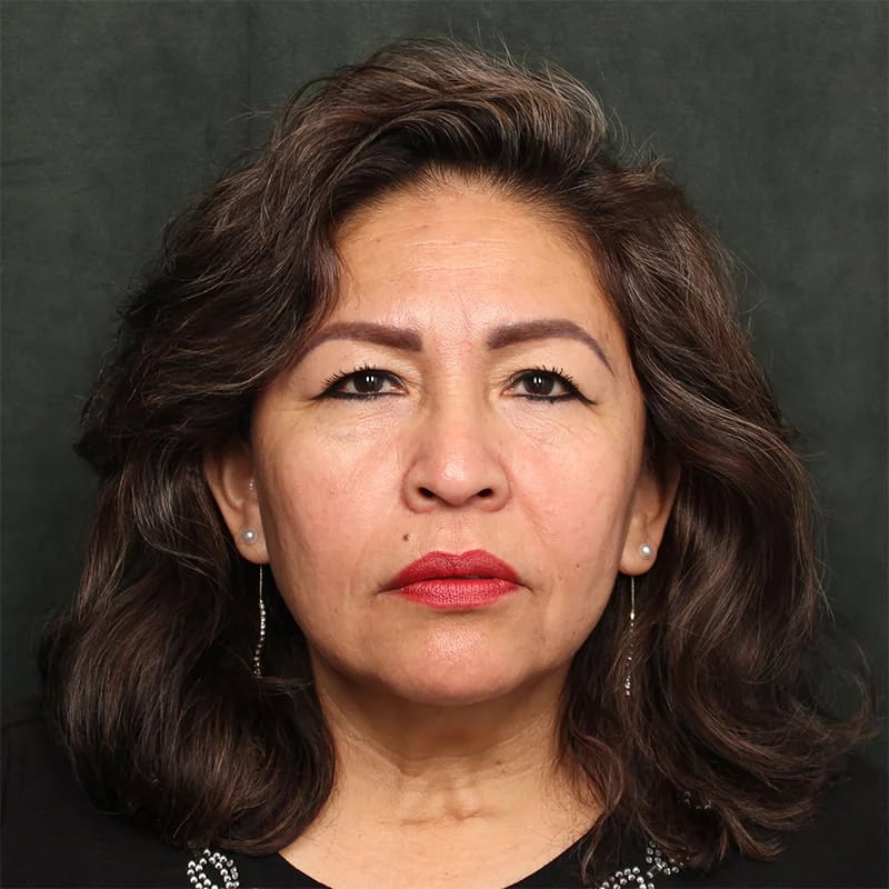Deep plane facelift Before & After Image