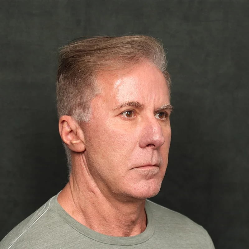 Deep plane facelift Before & After Image