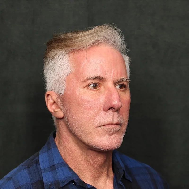 Deep plane facelift Before & After Image
