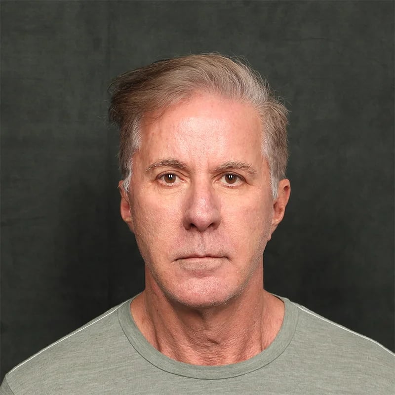 Deep plane facelift Before & After Image