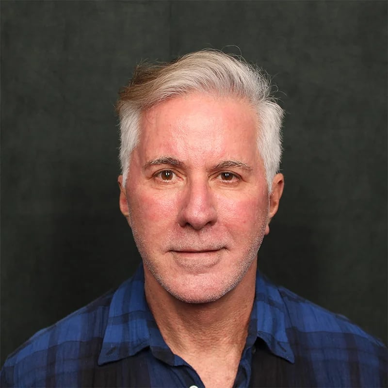 Deep plane facelift Before & After Image