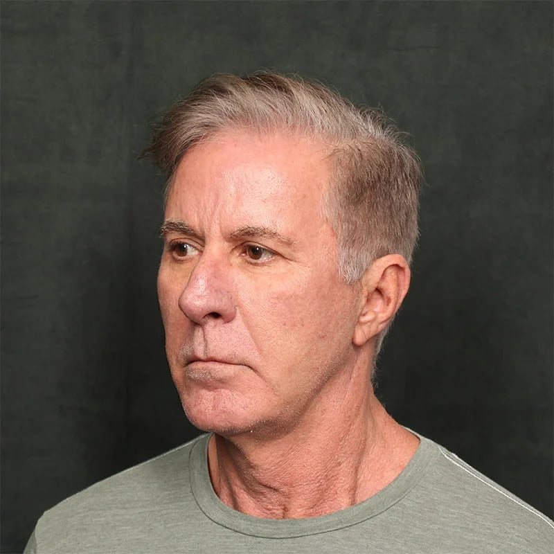 Deep plane facelift Before & After Image