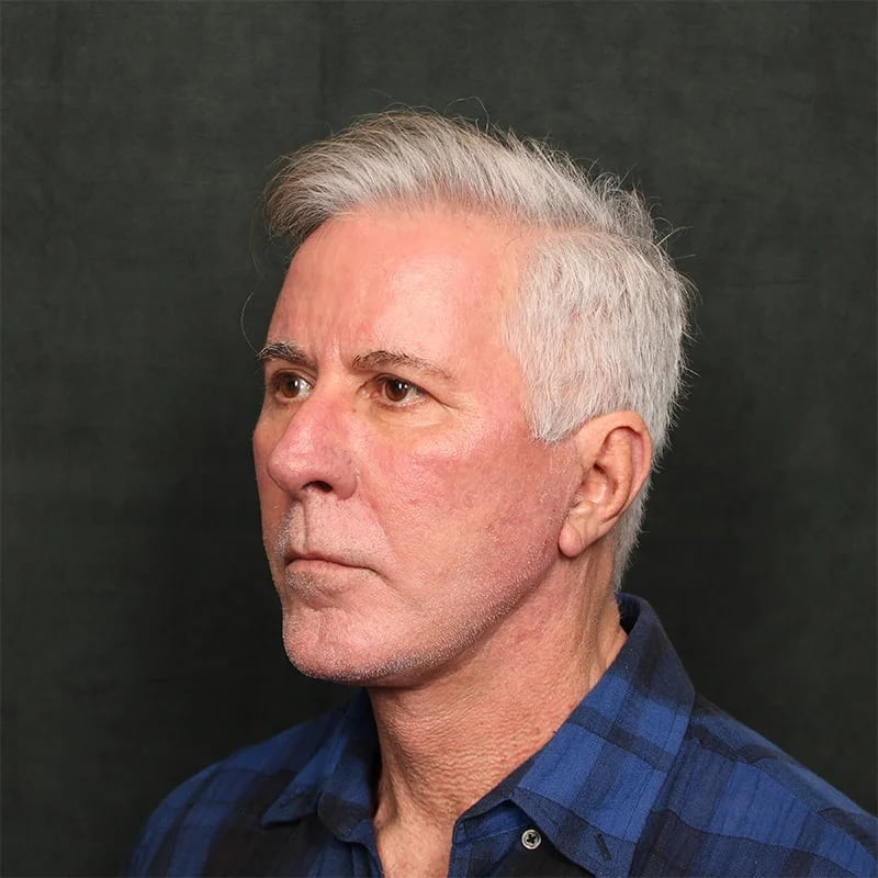 Deep plane facelift Before & After Image