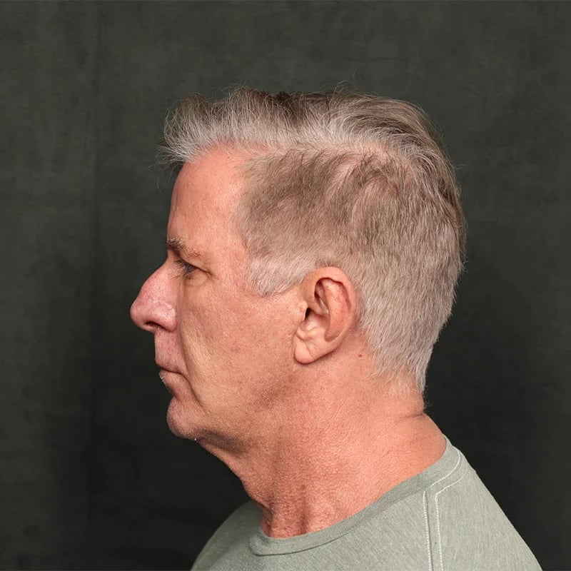 Deep Plane Facelift & Neck Lift Before & After Image