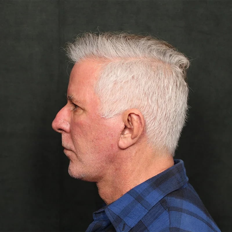 Deep Plane Facelift & Neck Lift Before & After Image