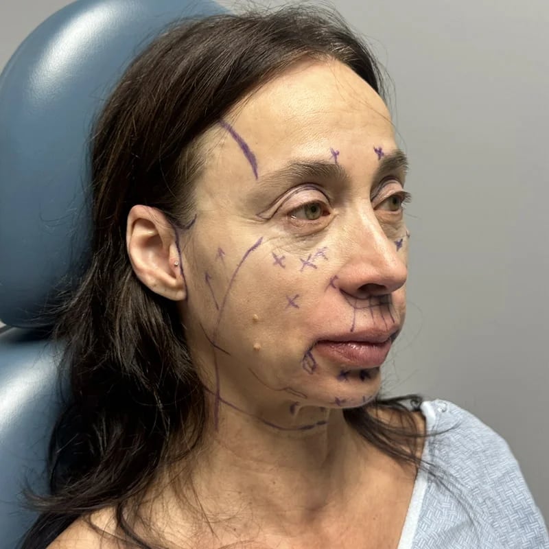 Deep plane facelift Before & After Image
