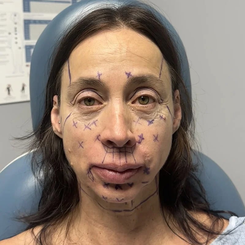 Deep plane facelift Before & After Image
