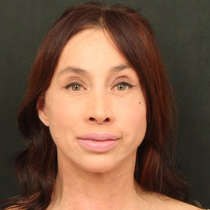 Deep plane facelift Before & After Image