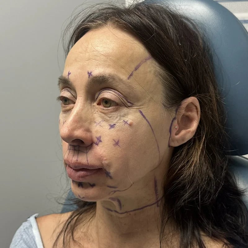 Deep Plane Facelift & Neck Lift Before & After Image