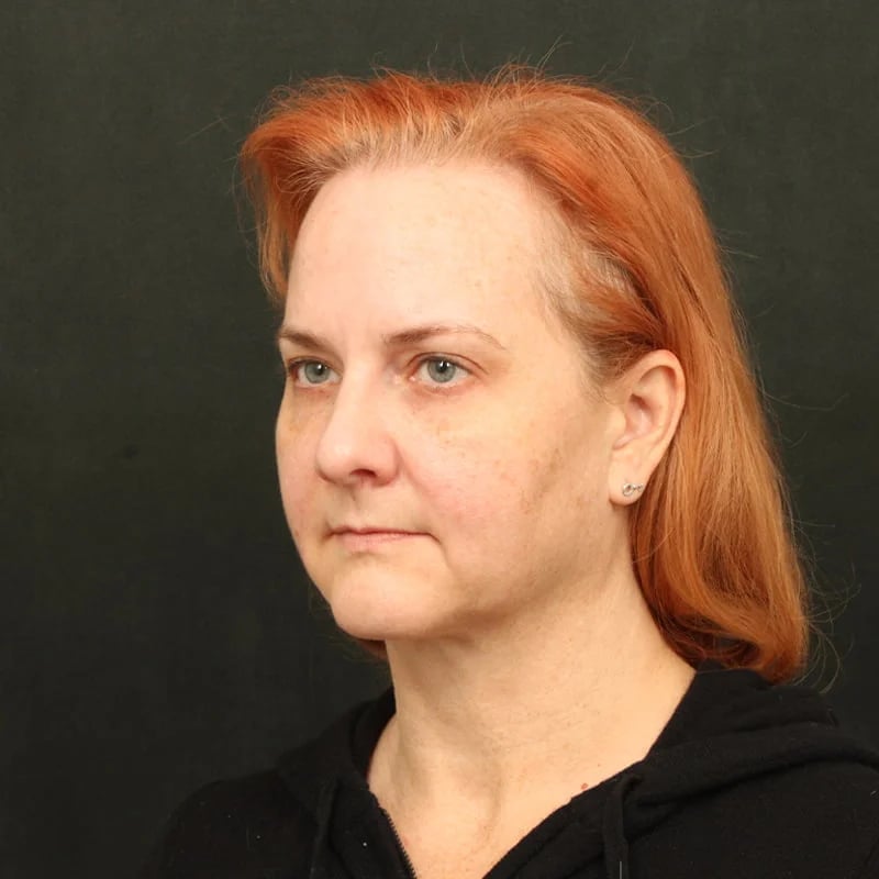 Deep Plane Facelift & Neck Lift Before & After Image