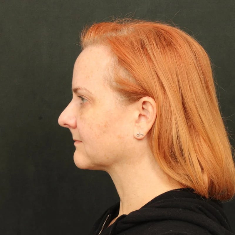 Deep Plane Facelift & Neck Lift Before & After Image