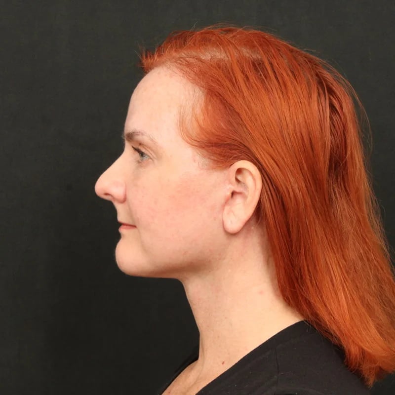 Deep Plane Facelift & Neck Lift Before & After Image
