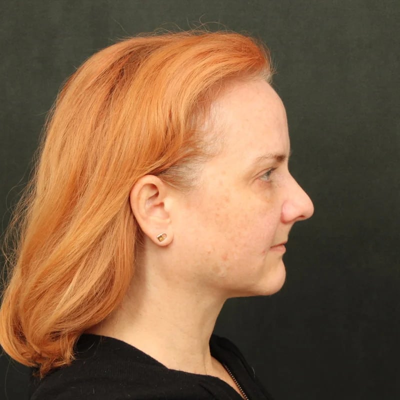 Deep Plane Facelift & Neck Lift Before & After Image