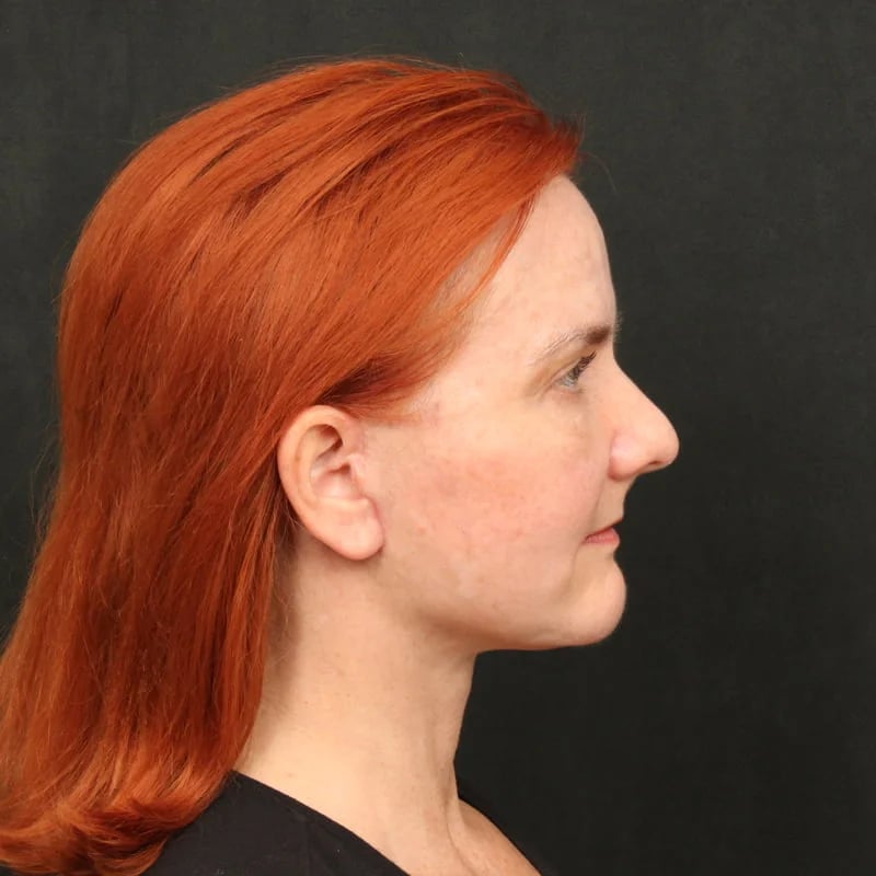 Deep Plane Facelift & Neck Lift Before & After Image