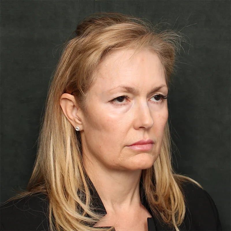 Deep plane facelift Before & After Image
