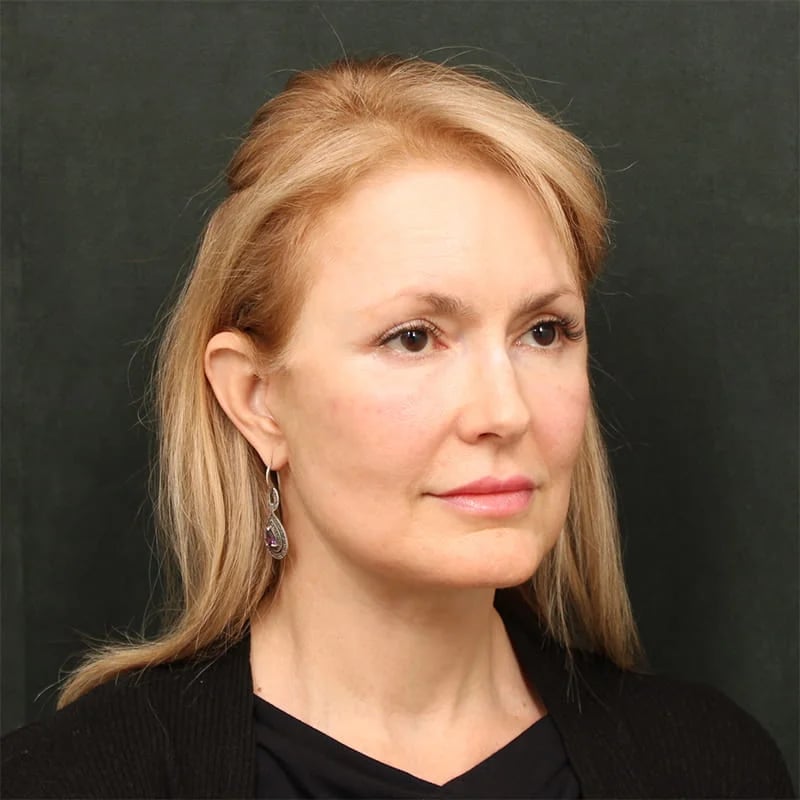 Deep plane facelift Before & After Image