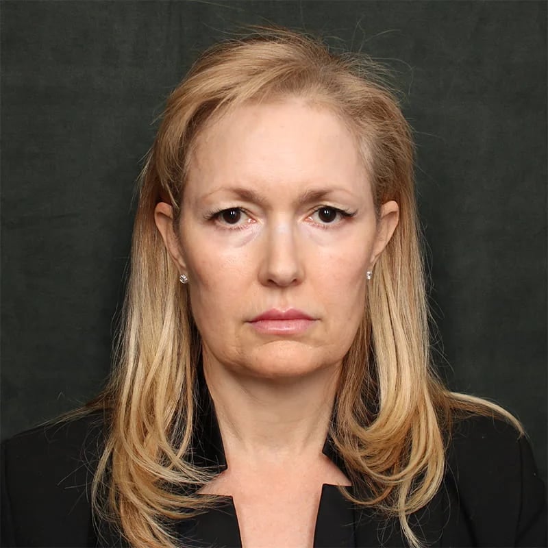 Deep plane facelift Before & After Image