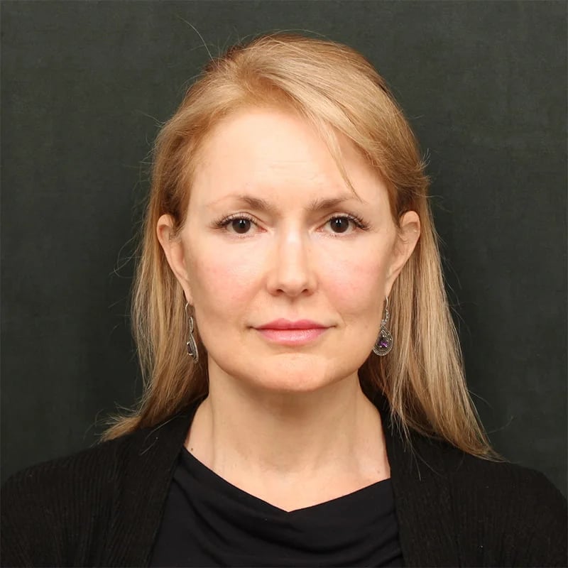 Deep plane facelift Before & After Image