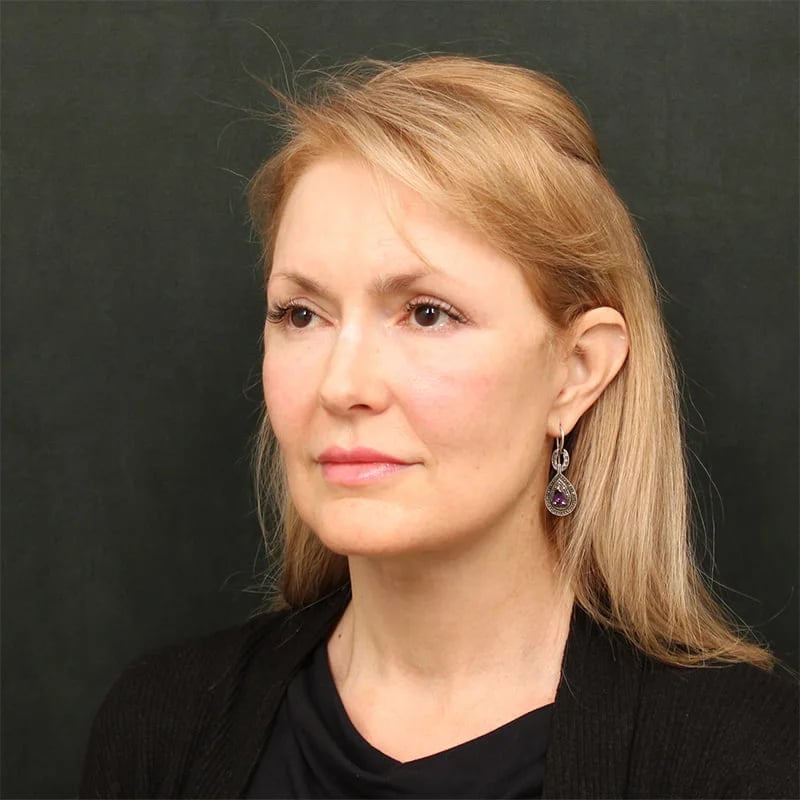 Patient After Photo