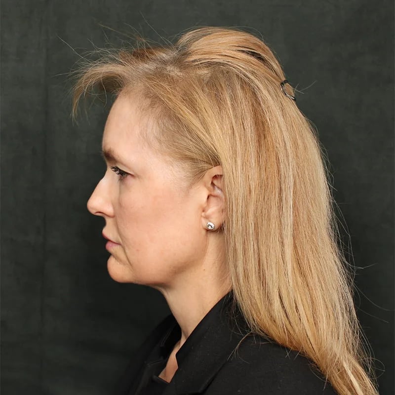 Deep Plane Facelift & Neck Lift Before & After Image