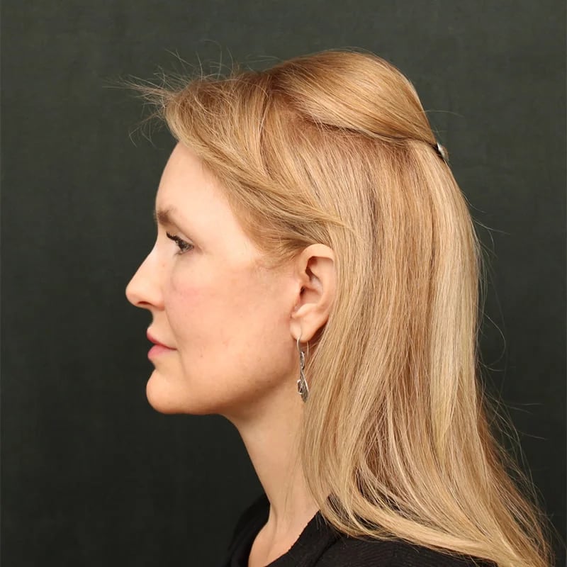Deep Plane Facelift & Neck Lift Before & After Image