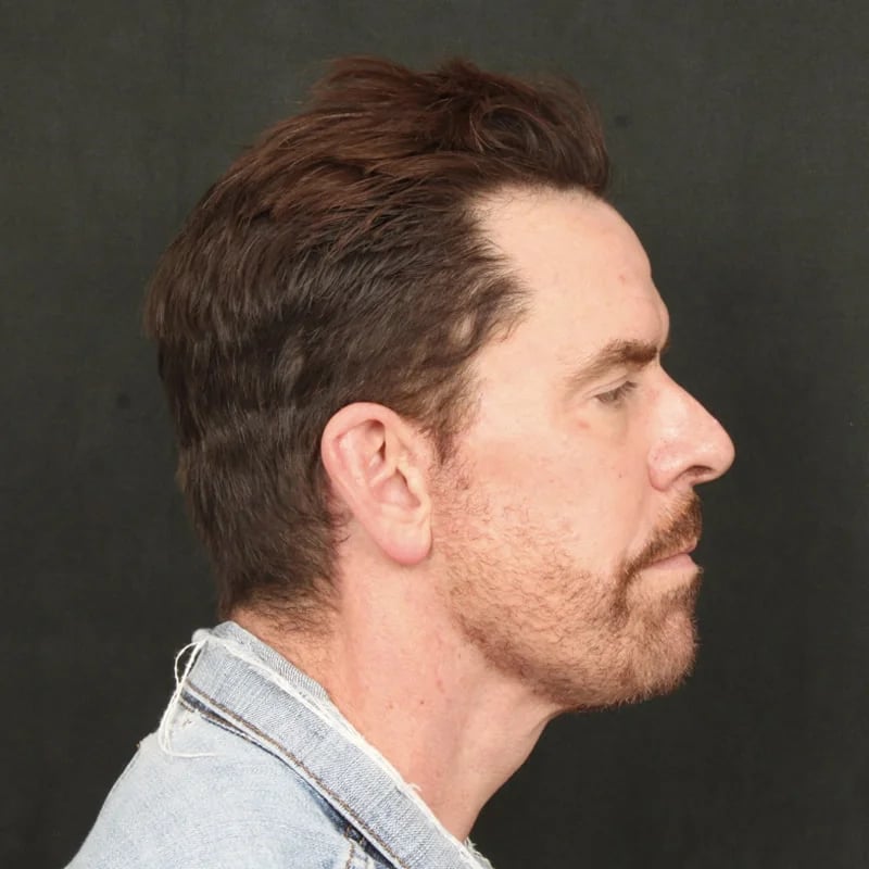 Deep Plane Facelift & Neck Lift Before & After Image