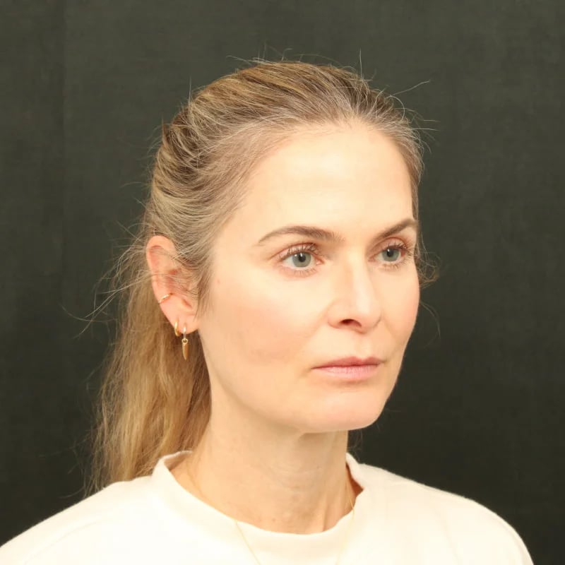 Deep Plane Facelift & Neck Lift Before & After Image